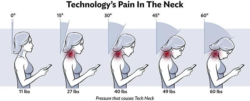 Technology's pain in the neck - increasing pressure on the neck and shoulders as smartphone posture worsens from 0 to 60 degrees